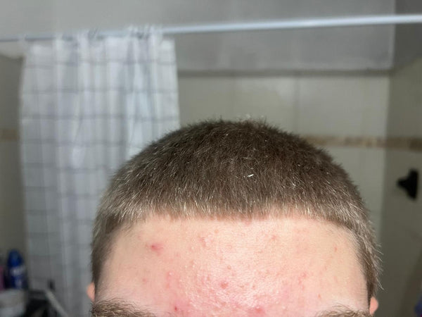 Antes